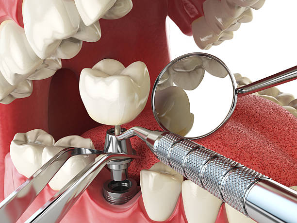 Best Emergency Denture Repair in Appleton, WI